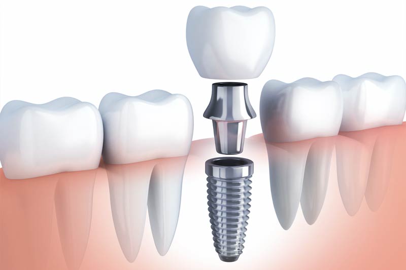 Implants Dentist in Timonium